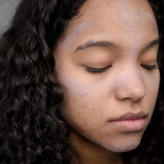 What causes acne?